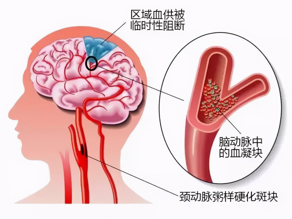 体检发现颈动脉斑块怎么办？